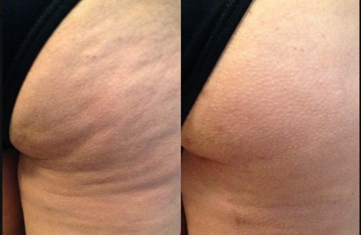 LA CELULITIS AFECTA HASTA AL 90 % DE LAS MUJERES: NEW BODY LANZA “NO MÁS CELULITIS EN COLOMBIA”